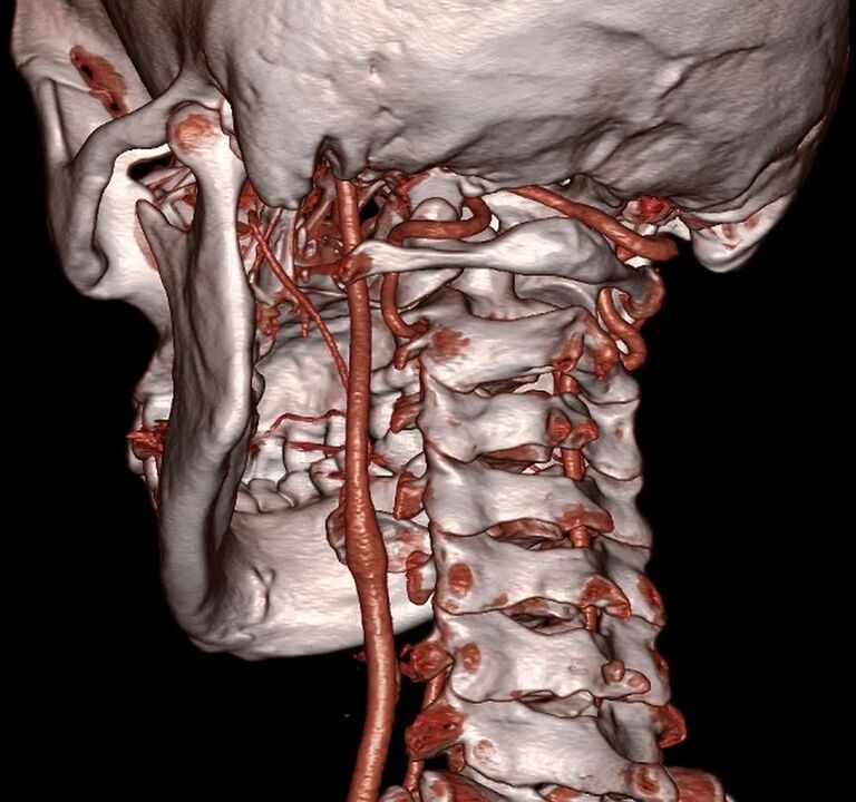 Cervical osteochondrosis compresses arteries
