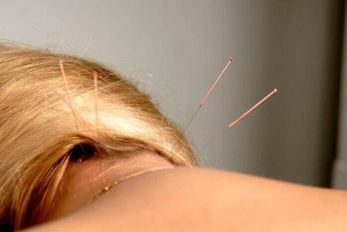 Acupuncture treatment of osteochondrosis