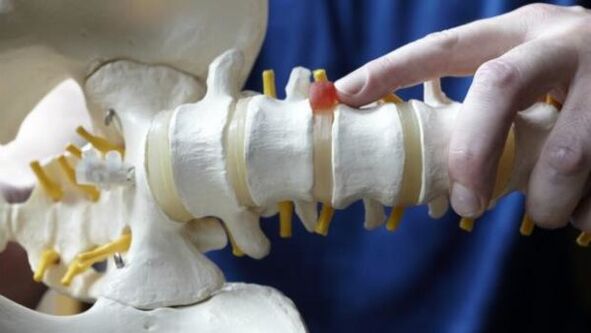 Lumbar disc herniation is the cause of back pain