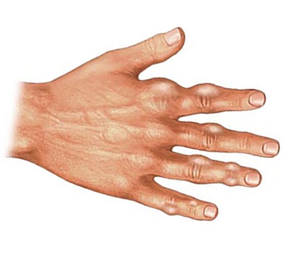 Deposition of uric acid crystals in soft tissues of fingers with gouty arthritis