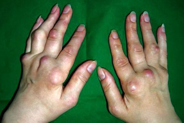 Hands affected by osteoarthritis deformans