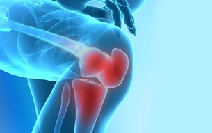 How does knee arthritis manifest
