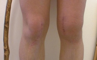 Stages of development of knee arthritis