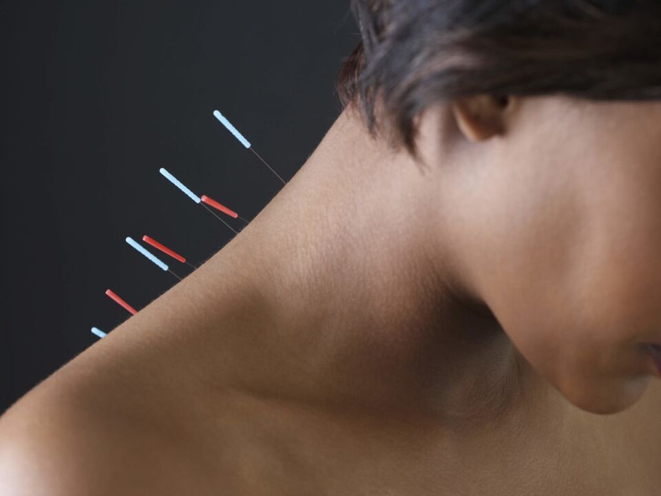 Acupuncture for cervical osteochondrosis eliminates inflammatory process