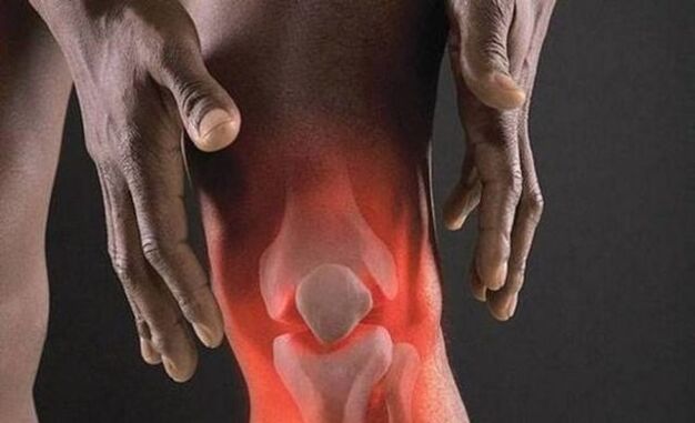 Arthritis with an inflammatory process in the knee joint